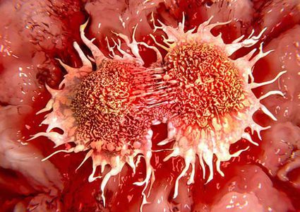 تعرفوا على أبرز أسباب الإصابة بسرطان الفم