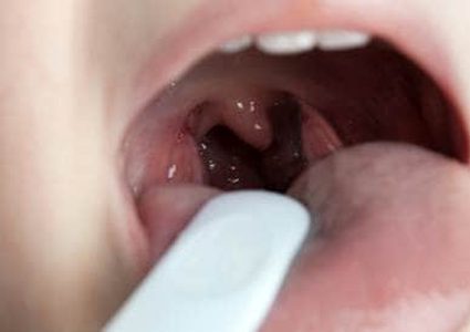 طرق علاج التهاب الحلق في الشتاء