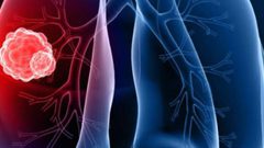 تحذير: تدلي الجفن قد يعني إصابتك بسرطان الرئة