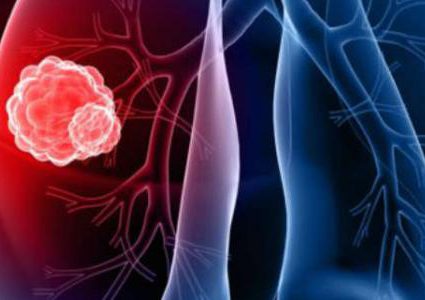 تحذير: تدلي الجفن قد يعني إصابتك بسرطان الرئة