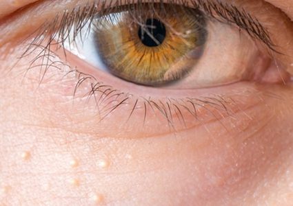 ما هو  المرض الذي تكشفه النتوءات الصفراء على الجلد ؟