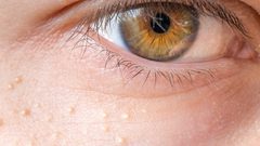 ما هو  المرض الذي تكشفه النتوءات الصفراء على الجلد ؟