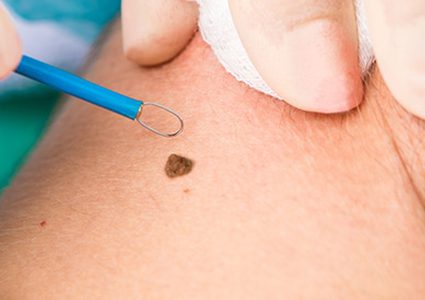 ما هي أكثر أعراض مرض سرطان الجلد شيوعا ؟