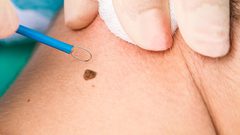 ما هي أكثر أعراض مرض سرطان الجلد شيوعا ؟