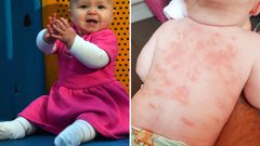 مرض نادر مرتبط بـ"كوفيد-19" يصيب طفلة تواجه حالة صحية خطيرة للأبد