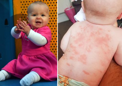 مرض نادر مرتبط بـ"كوفيد-19" يصيب طفلة تواجه حالة صحية خطيرة للأبد