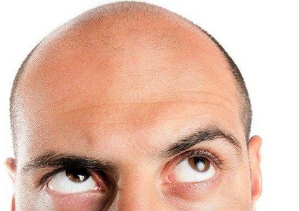 ما علاقة فيتامين B12 بمشكلة الصلع ؟