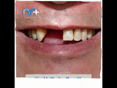 ما العلاقة بين الاصابة بكورونا وتساقط الاسنان؟