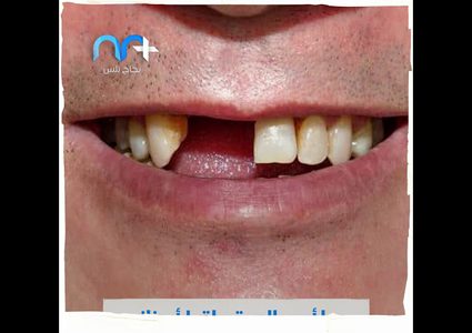 ما العلاقة بين الاصابة بكورونا وتساقط الاسنان؟