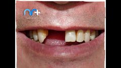 ما العلاقة بين الاصابة بكورونا وتساقط الاسنان؟