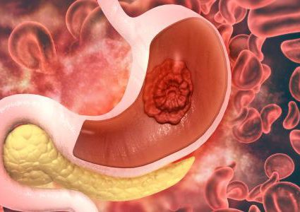 ما هي أعراض سرطان المعدة في المرحلة المبكرة؟