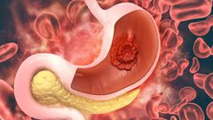 ما هي أعراض سرطان المعدة في المرحلة المبكرة؟