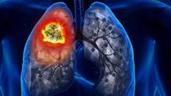 كيفية تشخيص سرطان الرئة بالنظر إلى صحة العينين ؟