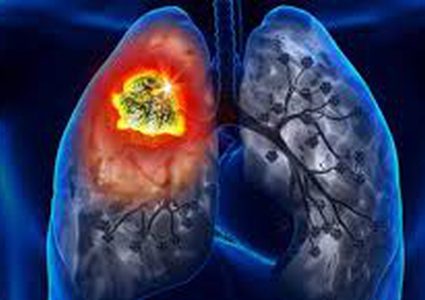 كيفية تشخيص سرطان الرئة بالنظر إلى صحة العينين ؟