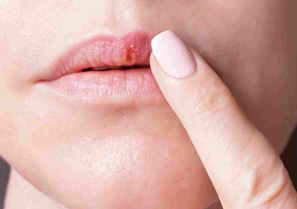 علماء: خدران الشفاه قد يعني الإصابة بسرطان الفم