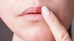 علماء: خدران الشفاه قد يعني الإصابة بسرطان الفم