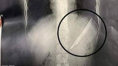 الأطباء يصنعون المعجزة.. مواطن مصري يبتلع سكينا طوله 27 سم