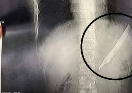 الأطباء يصنعون المعجزة.. مواطن مصري يبتلع سكينا طوله 27 سم