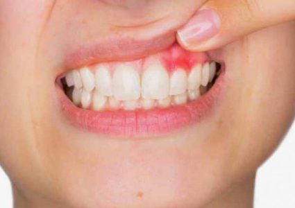 دراسة: أمراض اللثة تزيد من خطر الوفاة بفيروس كورونا