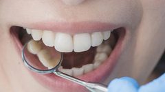 ماذا يحدث لأسنانك إذا لم تعالج التسوس؟