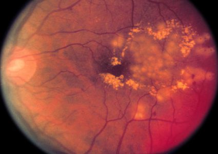 تأثير مرض اعتلال الشبكية السكري الإبصار