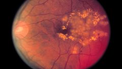 تأثير مرض اعتلال الشبكية السكري الإبصار