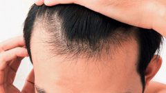 3 مكملات طبيعية تمنع أسباب الصلع الأندروجيني