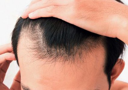 3 مكملات طبيعية تمنع أسباب الصلع الأندروجيني