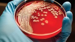 ما خطورة إصابة مرضى سرطان الدم بفيروس كورونا؟