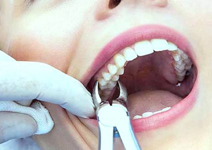 كيف يكون علاج الضرس في نهار رمضان؟