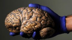 كيف يصل فيروس كورونا إلى الدماغ؟