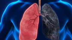 خبر سار.. علاج أميركي فعال لسرطان الرئة