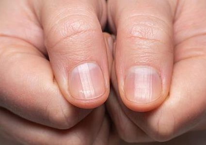 طريقة لكشف سرطان الرئة من حالة الأظافر