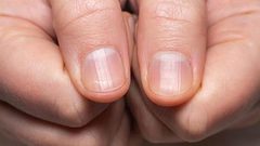 طريقة لكشف سرطان الرئة من حالة الأظافر