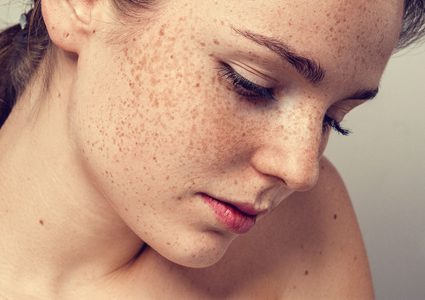 كيف يبدو النمش الخطير؟