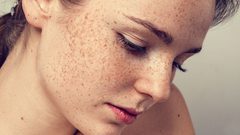 كيف يبدو النمش الخطير؟