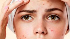 احذر.. عادات يومية تؤدي لظهور حب الشباب