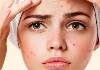 احذر.. عادات يومية تؤدي لظهور حب الشباب