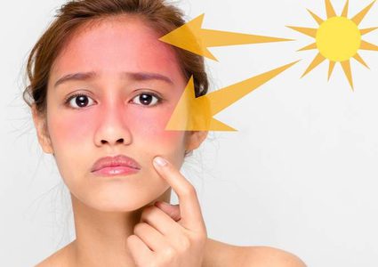 كيف نتعامل مع حروق الشمس؟