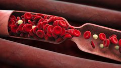 أعراض رئيسية يمكنها كشف الاصابة بتجلطات الدم