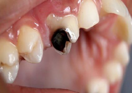 عادات شائعة تسبب تسوس الأسنان