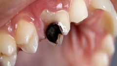 عادات شائعة تسبب تسوس الأسنان