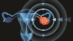 انتفاخ البطن المستمر.. علامة تحذيرية مبكرة لسرطان المبيض