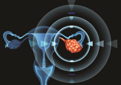 انتفاخ البطن المستمر.. علامة تحذيرية مبكرة لسرطان المبيض