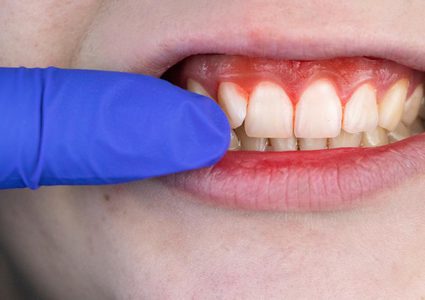 دراسة: نزيف اللثة علامة مبكرة على اعتلال عضلة القلب