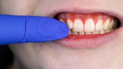 دراسة: نزيف اللثة علامة مبكرة على اعتلال عضلة القلب