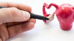 لُبَّادة تُوضّح العلاقة بين متلازمة تكيس المبايض ومشاكل البشرة