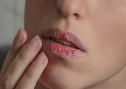 ما هي خطورة تشققات الشفاه ؟