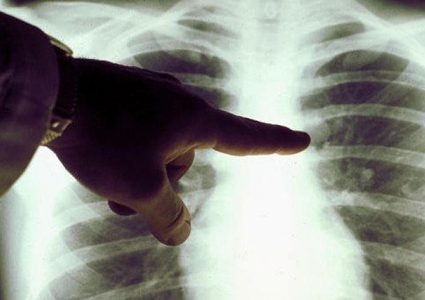 دراسة: الألم في الكعب قد يدل على الإصابة بسرطان الرئة