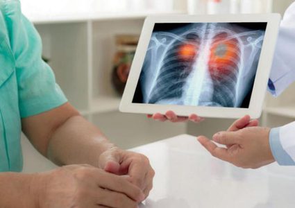 الصحة: 70% من مرضى سرطان الرئة في فلسطين هم من المدخنين